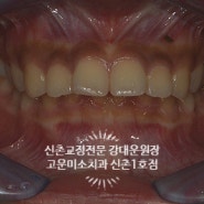 윗니돌출, 입술돌출, 과개교합을 가지신 환자분의 2급 부정교합치료증례 신촌교정치과 고운미소 신촌1호점 치료증례