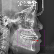 성남 치과 벌어진 치아 주걱턱 인비절라인 활용한 교정 & 치근단 염증 충치 크라운 보철 치료