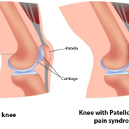 [대구운동재활PT]무릎대퇴통증증후군이란 무엇일까요?