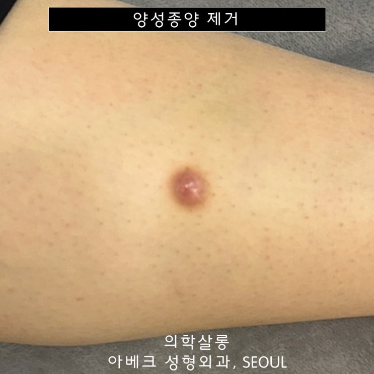 피부섬유종 제거 : 검고 붉고 딱딱한 혹 괜찮은걸까? 【Dr. 아베크 양성종양】 : 네이버 블로그