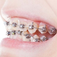치아교정 장치가 망가졌을 때 대처 방법