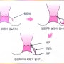 치루 치핵 증상 대처 방법은?