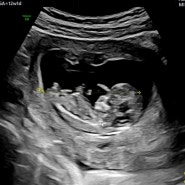 # 임신기록 : 두근두근 1차 기형아 검사 이상 무!! 목 투명대 두께 0.9mm 정상