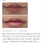 압구정 입술필러 잘하는곳? 의사가 생각하는 기준은