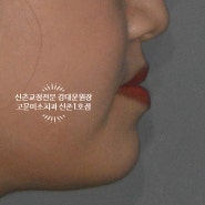 아랫입술돌출, 앞니 빈 공간이 있는 3급 부정교합 비발치 치료증례 신촌교정치과 고운미소 신촌1호점 치료증례