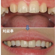 [임플란트가 불가능한 경우]치아가 없는 부위 잇몸뼈가 너무 얇아 임플란트를 할 수가 없을 때 어떻게 치료하나요?