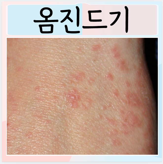 옴 진드기 증상 간지러움 진단 치료 : 네이버 블로그