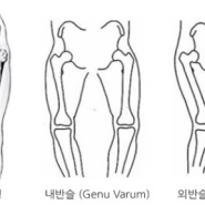 O다리(내반슬), X다리(외반슬) 부산 도수치료로 해결하기.