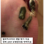 발바닥 사마귀 초기부터 방치하지 않고 제거