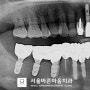 보철 아래 생겨나는 이차 충치로 인해 소하동 치과 에서 발치 후 임플란트 식립한 사례