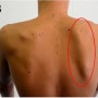 과천PT : 어깨 불균형의 원인인 견갑기능이상증(scapular dyskinesis)을 해결하기 위한 재활운동방법