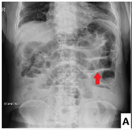 장폐색(Bowel Obstruction): introduction, 병인 : 네이버 블로그