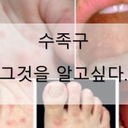 수족구병(hand-foot-mouth dz)안양 수족구 평촌 수족구 정보를 알려드립니다.