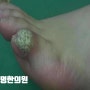 새끼 발가락 사마귀는 원인 제거로 무조건 초기 치료해 됩니다