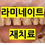 [분당/정자동/정자역 치과] 라미네이트 변색과 충치, 재치료