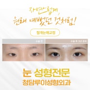 제주눈성형 잘하는곳, 원래 예뻤던 것처럼 자연스러운 쌍수 후기