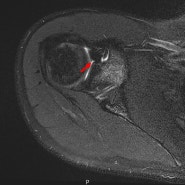 어깨 탈구? 관절와순 파열? 정상 관절와순 변이
