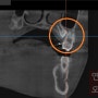 청량리 교정치과 치아가 안나와요 (매복치)