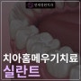 영구치에 실란트를 하면 충치가 안 생기나요? @ 대치동소아치과 연세정원치과