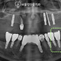 [ 관악구 치과 ] 임플란트 주위염(implantitis) 발생 원인 및 해결에 대한 글