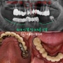 치아 상실 및 오래된 보철로 식사가 어려웠던 분, 신림 치과 GBR을 동반한 70대 임플란트 수술 과정