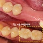 명일동 치과 어금니, 앞니 임플란트 하시러 오신 30대 무절개 임플란트 수면마취 증례 소개