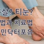 굳은살에 통증이 느껴지는 티눈, 손톱깎이로 티눈 제거하면 안 되는 이유