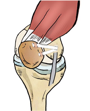 Knee- Open MPFL reconstruction using allograft / internal brace / TT ...