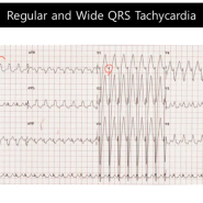 22. 심실빈맥이 아닌데 왜 QRS가 넓게 보일까? SVT with BBB
