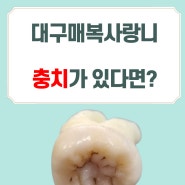 대구매복사랑니 충치가 발견된다면?