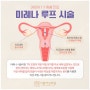 마천동여의사산부인과 미레나 언제 받는 것이 좋을까?