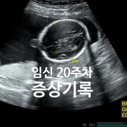 [임신20주차]증상/배뭉침,태동,붓기,체중증가,불면증