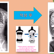 틀어진 골반, 휜 척추- 척추측만증보조기로 교정 완료- 원남보조기 착용사례