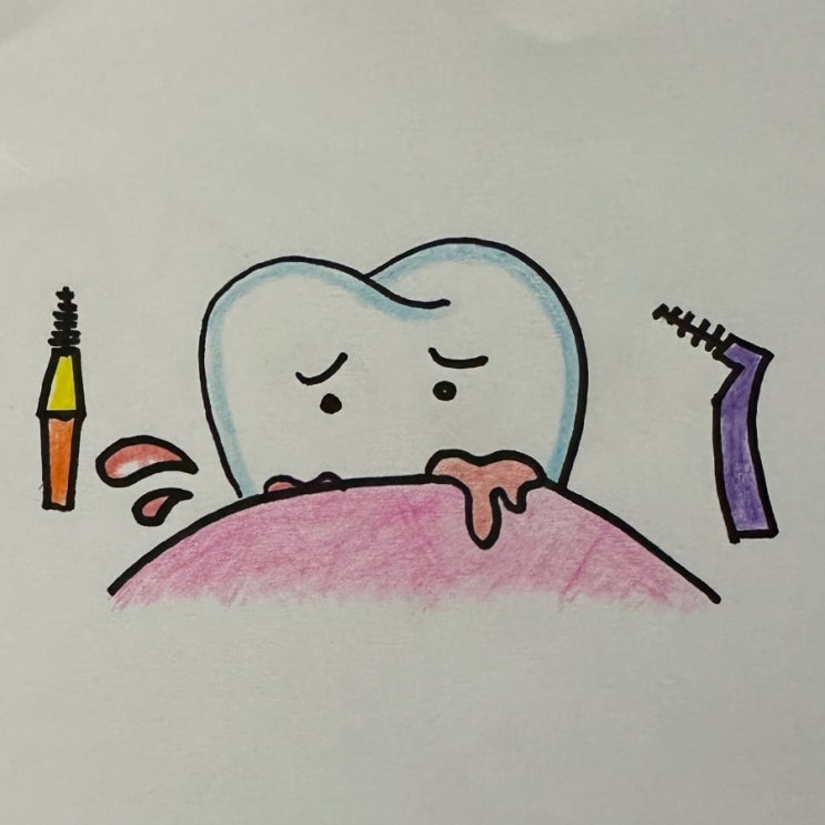 급성괴사성궤양성치은염 ANUG(acute necrotizing ulcerative gingivitis) 청천동잇몸치료 산곡동잇몸 ...