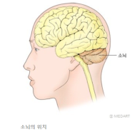 소뇌 실조란 무엇일까?