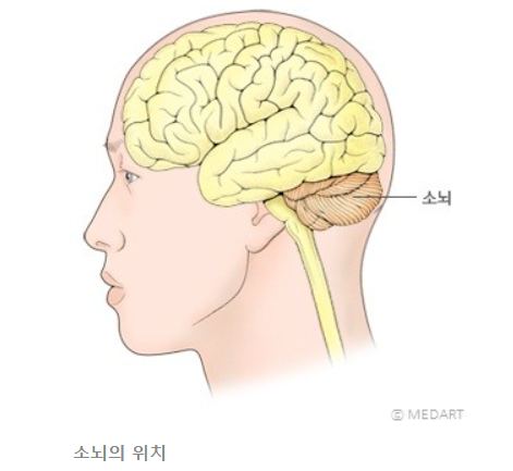 소뇌 실조란 무엇일까? : 네이버 블로그