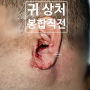 귀 상처 봉합 후기 (성형외과 병원 치료 흉터)[서울 경기 송파구 강동구 강남구 하남 미사 중랑 용산 건대]