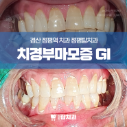 치경부마모증 GI 치료 과정 (+ 매복사랑니 발치 후기)