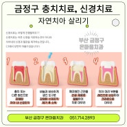 금정구 충치치료, 신경치료 잘하는 치과