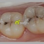 어금니 충치 예방 및 초기 치료방법