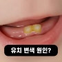 유아의 치아 변색 원인과 치료 방법은?