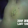 발바닥 사마귀 제거 후 40년 동안 고통 받은 사연