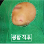 어린이 턱 상처 봉합 후기 (성형외과 병원 치료 흉터)[서울 경기 송파구 강동구 강남구 하남 미사 중랑 용산 건대]