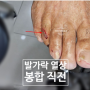 발가락 상처 봉합 후기 (발 수부 성형외과 병원 치료 흉터)[서울 분당 판교 송파 강동 강남 하남 미사 중랑 용산 건대]