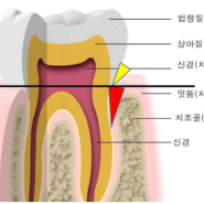 상대동치과 유성구치과 대전일요일치과 - 잇몸 염증 치료 (연세정원치과)