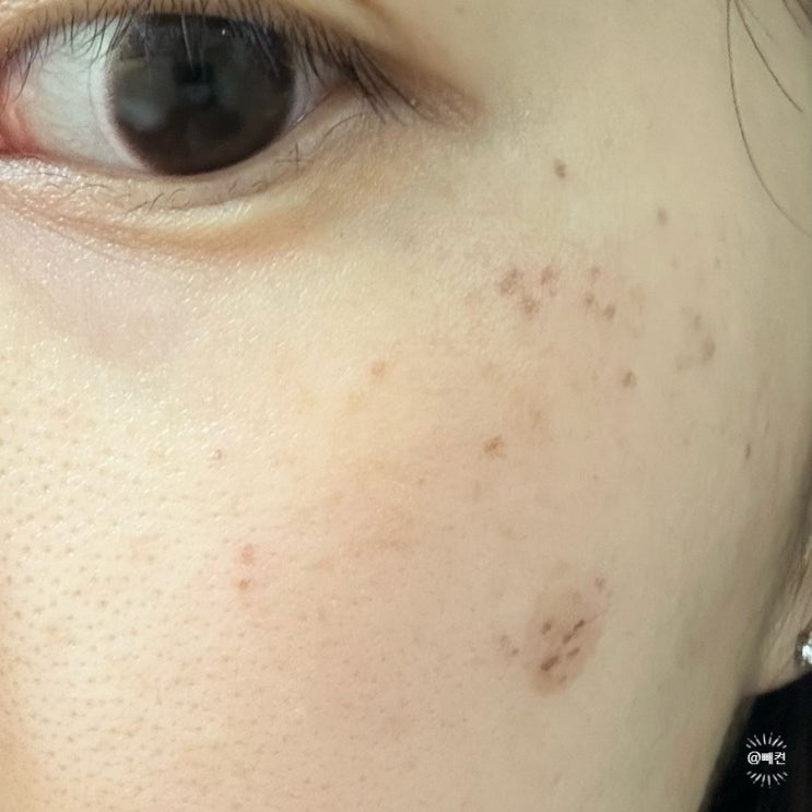 얼굴 눈밑 기미 잡티 제거 없애는 방법 : 네이버 블로그
