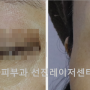 흑자를 한 번에 없애는 데 가장 중요한 치료기법은 특정장비가 아닌 치료 후 환부 관리에 있다.