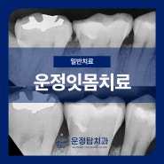 운정잇몸치료 잇몸이 붓고 양치할 때 마다 피가나요