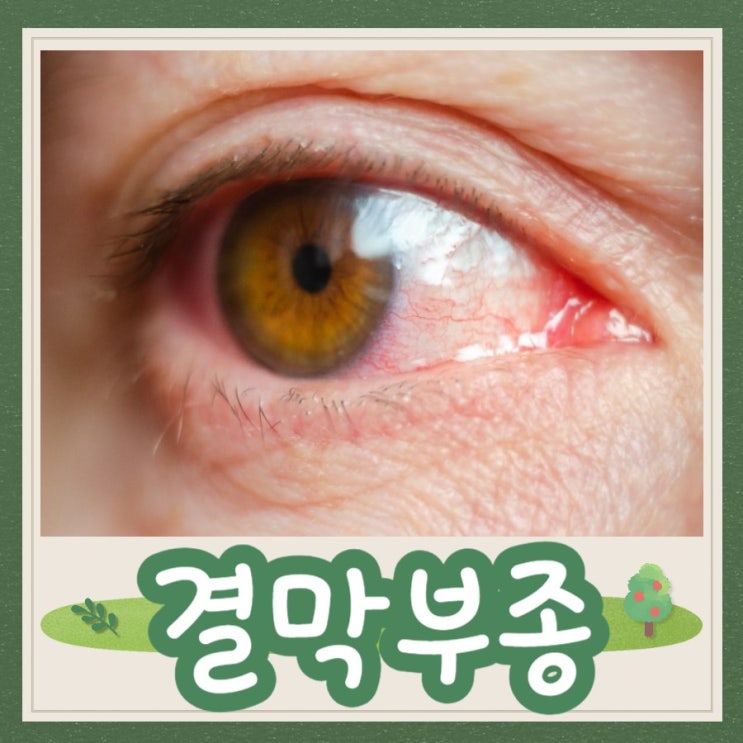 결막부종 원인 증상 치료 안약 전염 눈 물집 부음 : 네이버 블로그