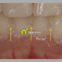 “잇몸이 부었어요” 잇몸 염증 어떻게 치료할까?